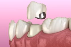 Восстановление зуба коронкой металлокерамической