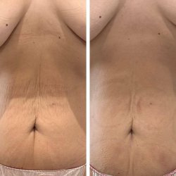 Программа "Подтяжка"