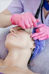 Алмазная микродермабразия лица