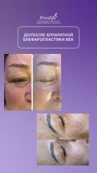 Аппаратная блефаропластика век