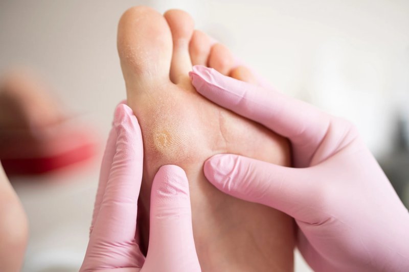 Обработка мозолей 1–2 шт