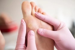 Обработка мозолей 1–2 шт