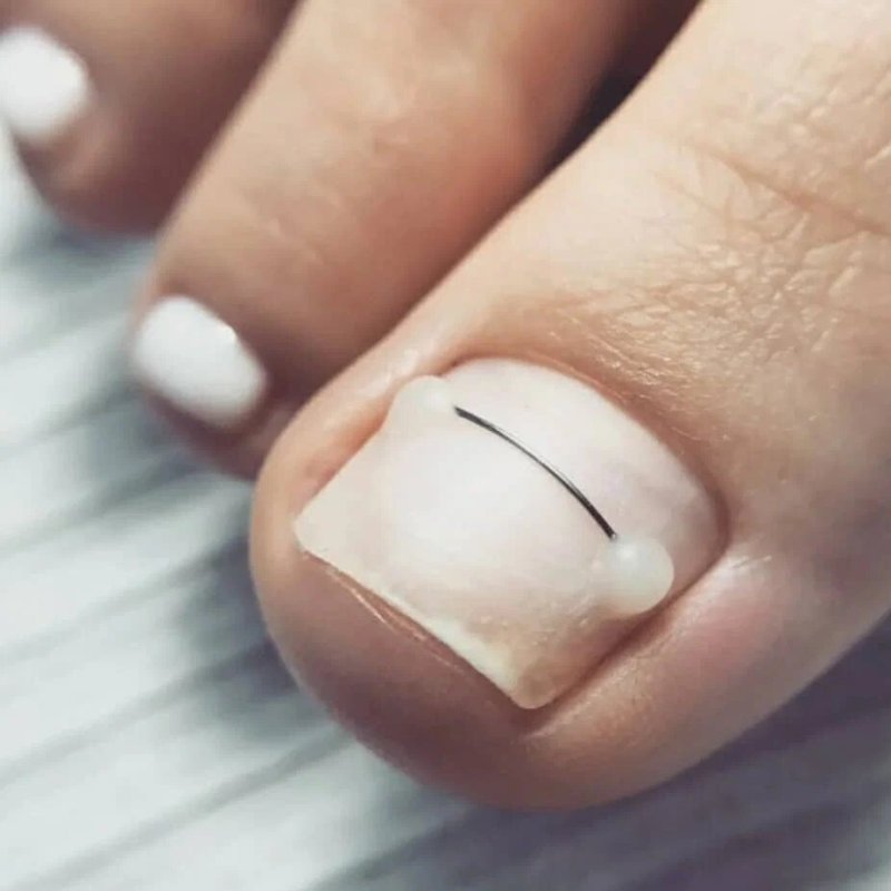 Исправление ногтевой пластины с помощью проволоки