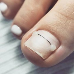 Исправление ногтевой пластины с помощью проволоки