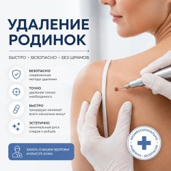 УДАЛЕНИЕ РОДИНОК
