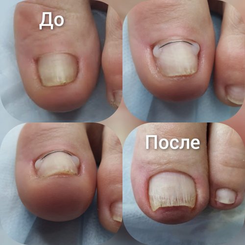 работа подолога по коррекции ногтя