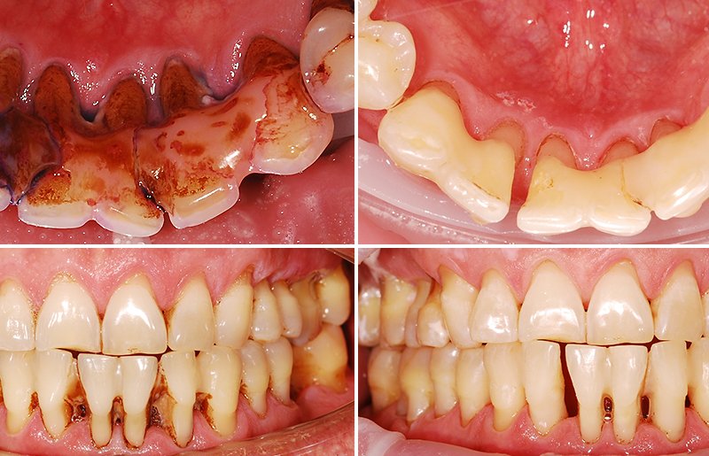 Лечение пародонтита в стоматологии V.I.A.Dent г. Сочи 
