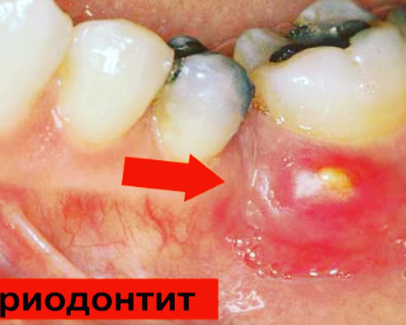 Лечение периодонтита в стоматологии V.I.A.Dent