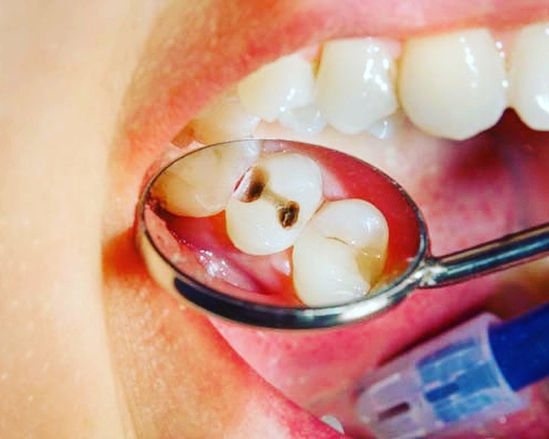 Лечение кариеса в стоматологии V.I.A.Dent г. Сочи