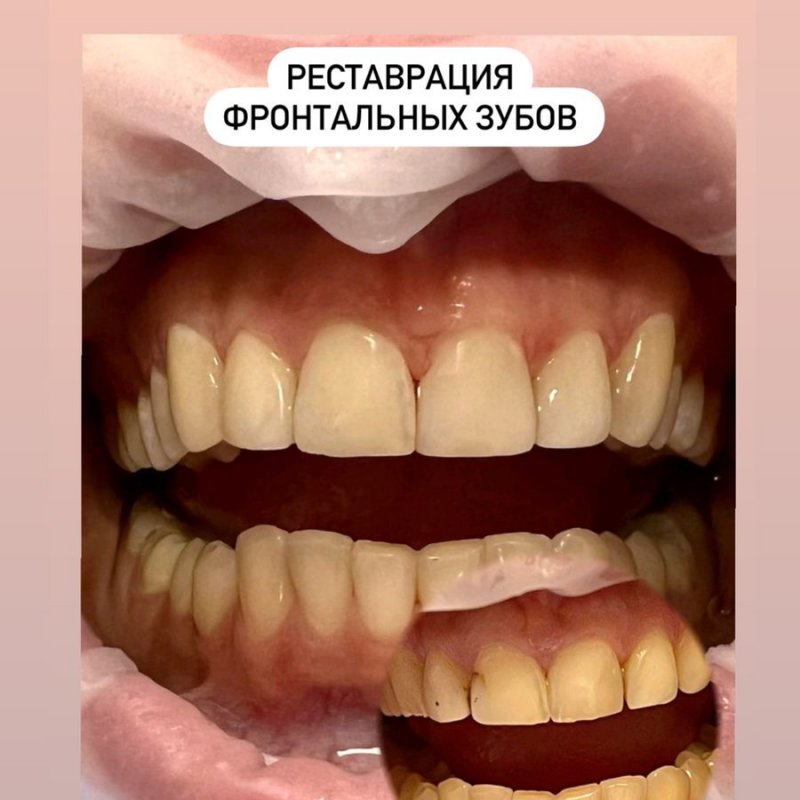 Реставрация зубов 7500р, Сочи!