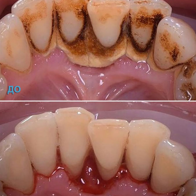 Удаление зубного камня в стоматологии V.I.A.Dent г. Сочи