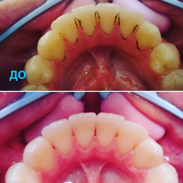 Удаление зубного налета в стоматологии V.I.A.Dent г. Сочи