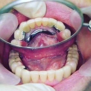 Установка бюгельного протеза в стоматологии V.I.A.Dent в г. Сочи