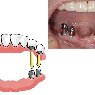 Установка телескопических протезов в стоматологии V.I.A.Dent г. Сочи