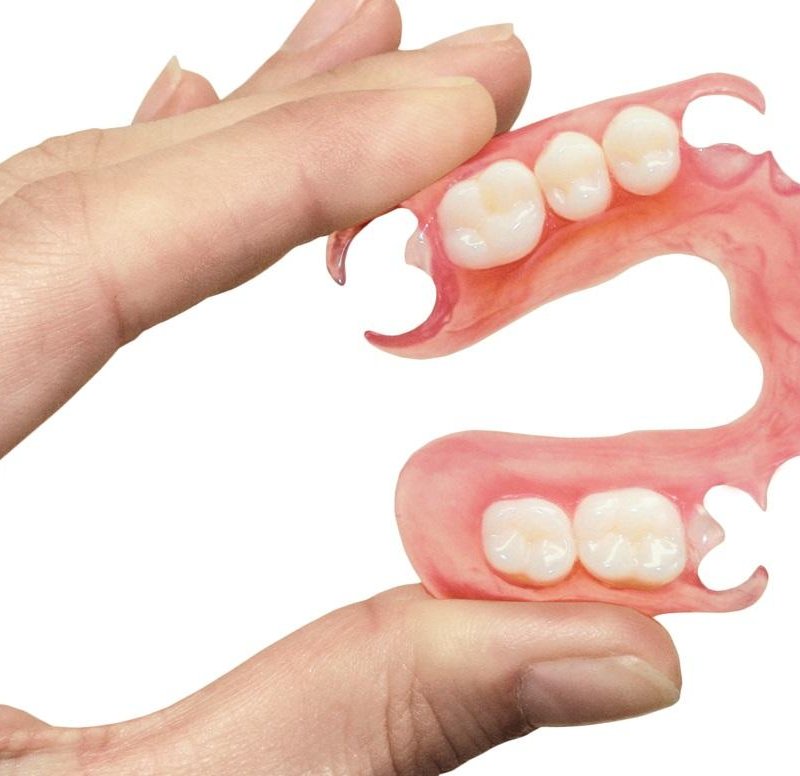 Установка нейлоновых протезов в стоматологии V.I.A.Dent г. Сочи