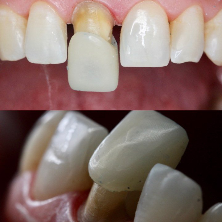 Установка временных коронов в стоматологии в стоматологии V.I.A.Dent г. Сочи
