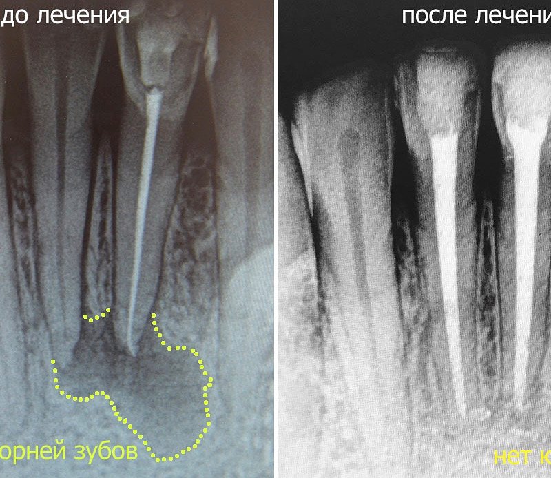  Лечение кисты зуба в стоматологии V.I.A.Dent в г. Сочи 