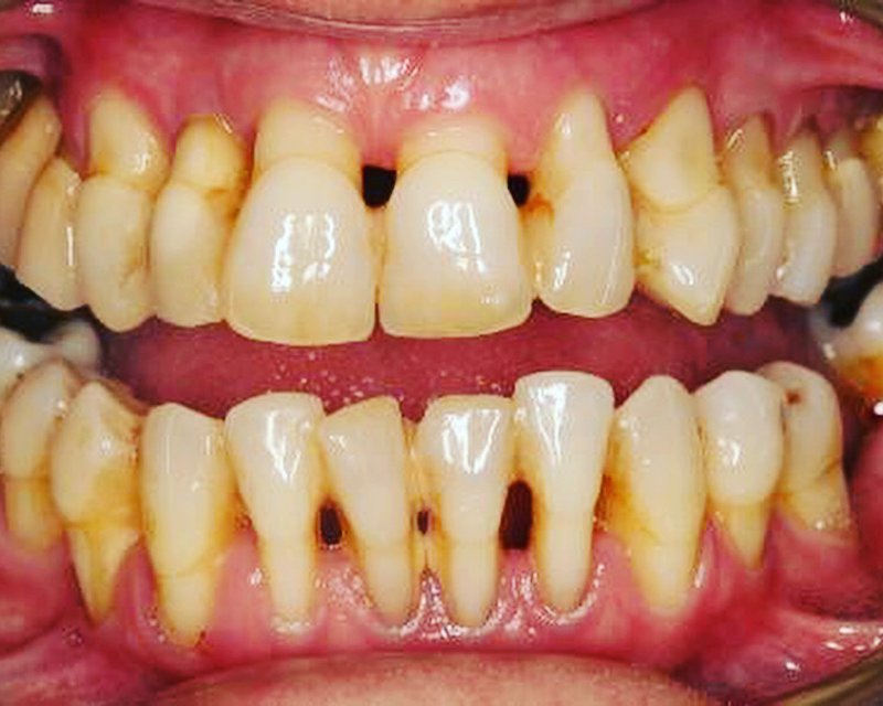 Лечение пародонтоза в стоматологии стоматологии V.I.A.Dent г. Сочи