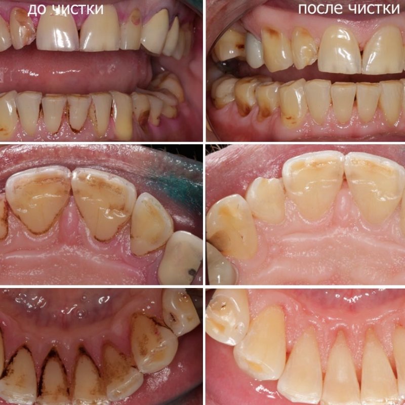 Профессиональная чистка зубов в стоматологии "V.I.A.Dent" г. Сочи 