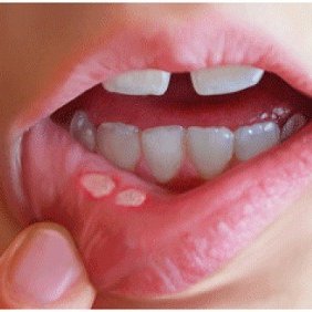  Лечение стоматита в стоматологии в стоматологии "V.I.A.Dent" г. Сочи