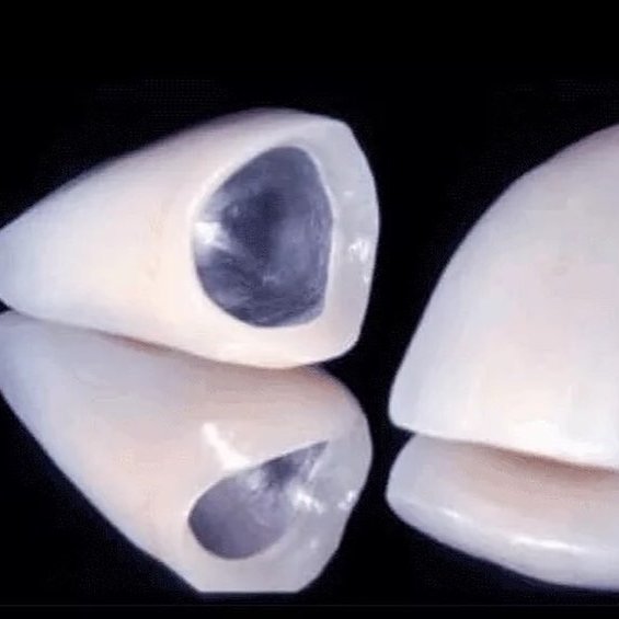 Установка металлокерамических коронок с плечевой массой в стоматологии "V.I.A.Dent" г. Сочи