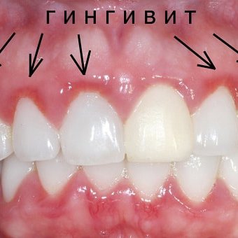 Лечение гингивита в стоматология "V.I.A.Dent" г. Сочи