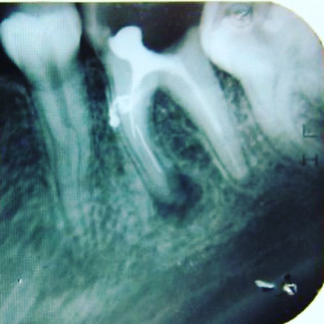 Лечение гранулемы зубы в стоматологии "V.I.A.Dent" г. Сочи