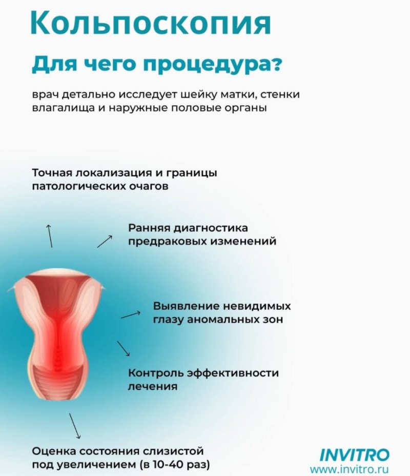Проведение кольпоскопии в МО ИНВИТРО !!!