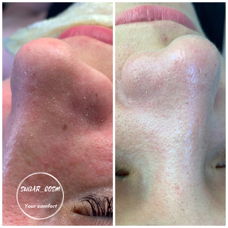 12-ступенчатая комбинированная аппаратная чистка лица