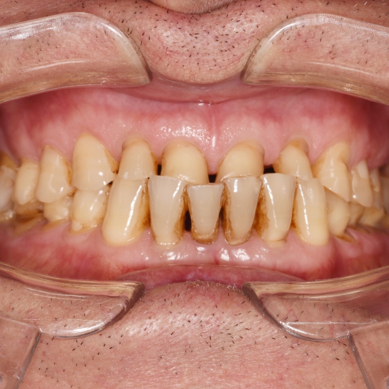 Патологическая стираемость зубов - это прогрессирующая убыль твёрдых тканей зубов с уменьшением их высоты или толщины коронковой части.