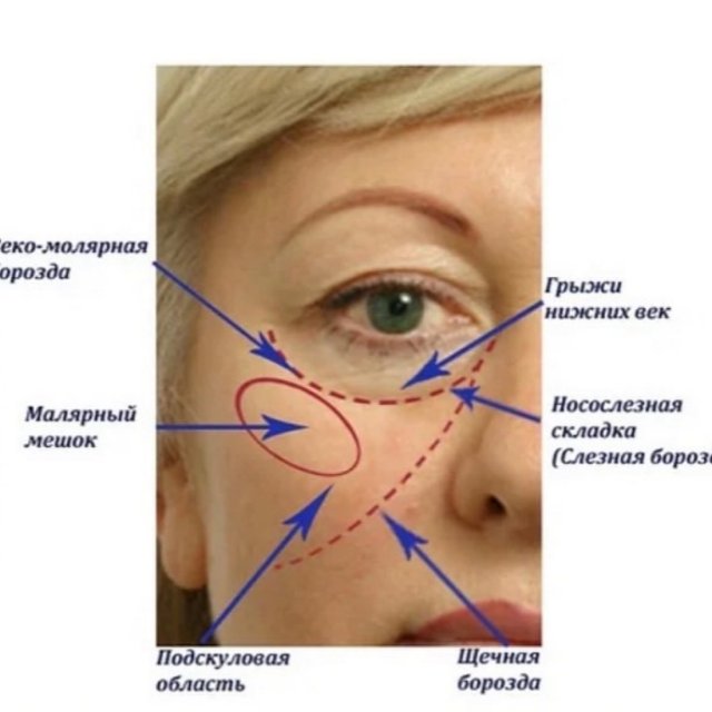 Предпосылки формирования возрастных изменений периорбитальной области (вокруг глаз).