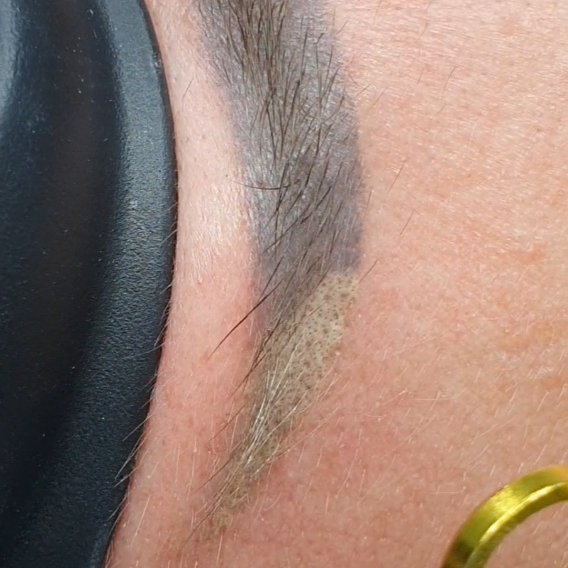 Как выглядит кожа после лазерного удаления татуажа бровей?