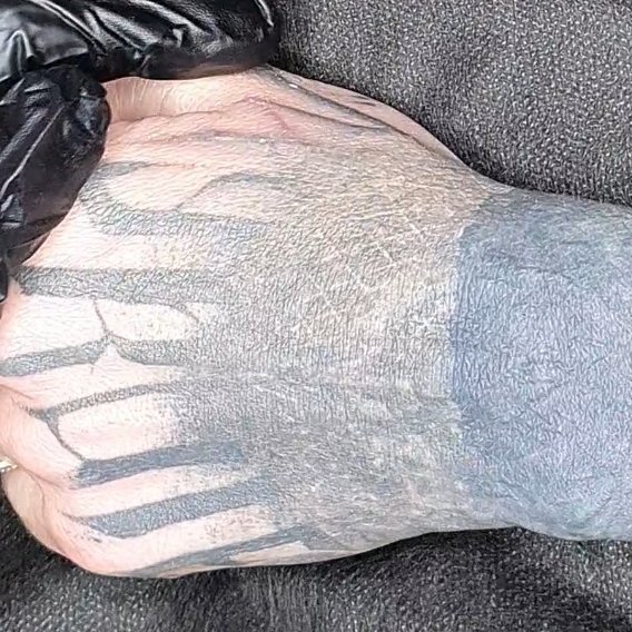 Лазерное удаление тату на кисти