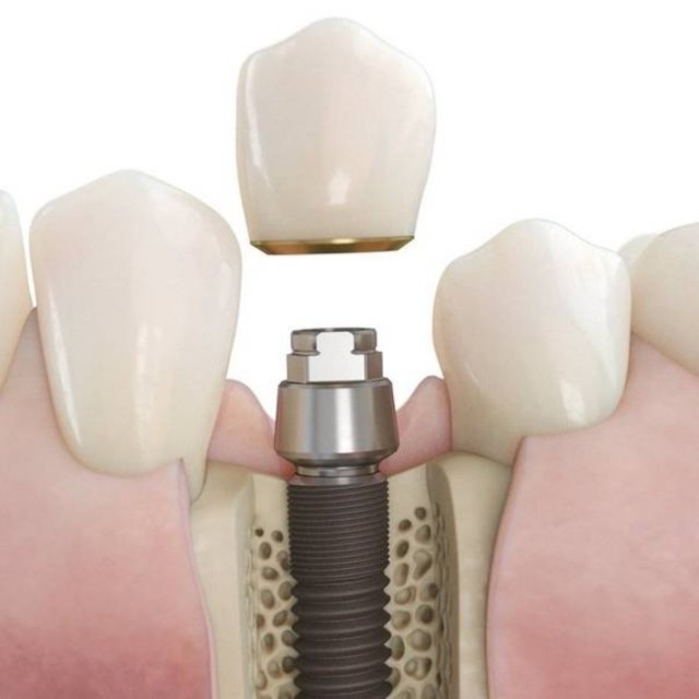 Восстановления зуба потерянного в результате травмы или заболевания