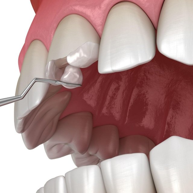 Восстановление зубов. Стоматология Октябрьский 