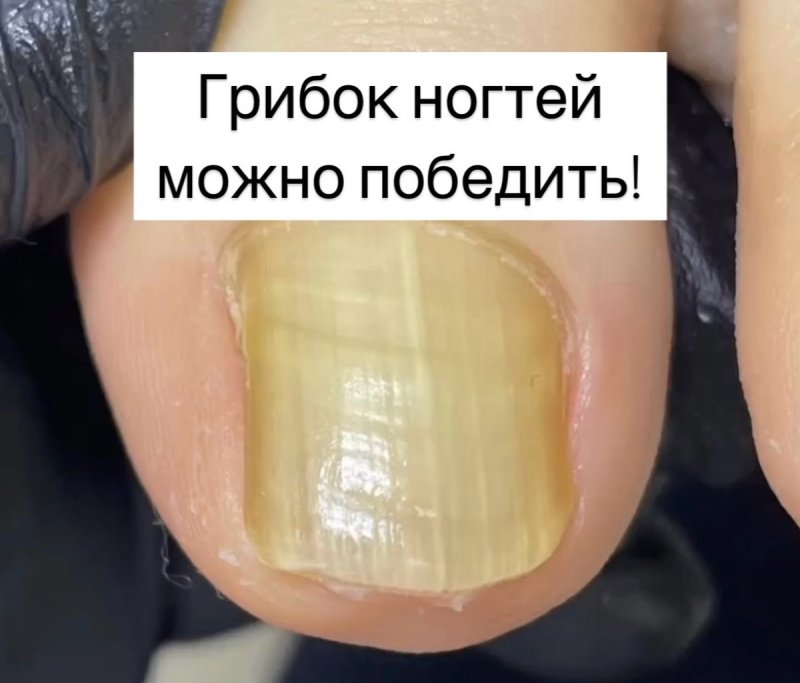 💚 Грибок ногтей можно победить💚