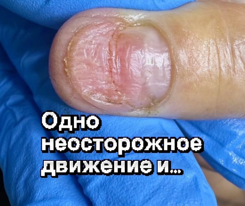 Травма пальца и помощь подолога.