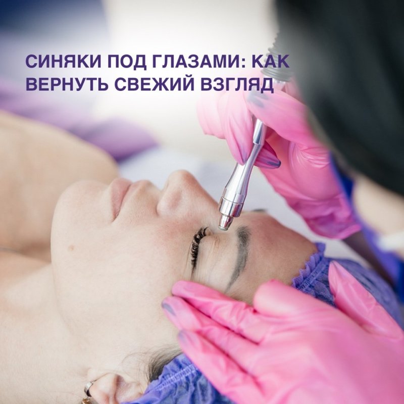 Синяки под глазами: как вернуть свежий взгляд😍