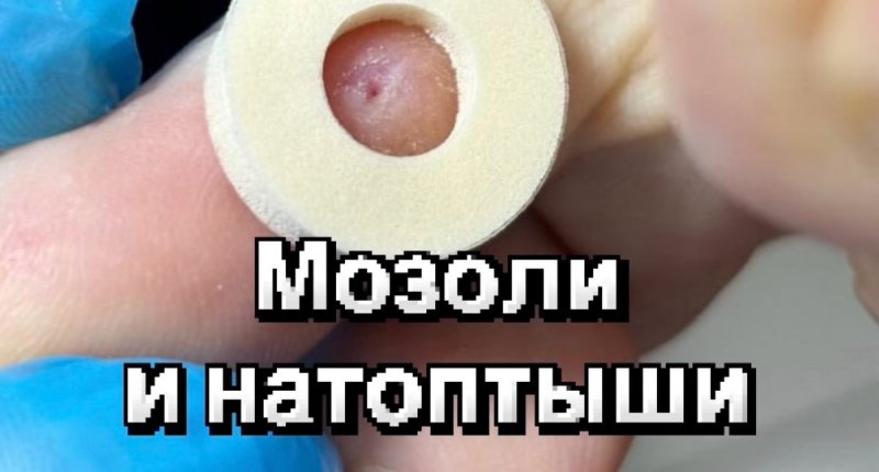 Натоптыши и мозоли. Что делать?