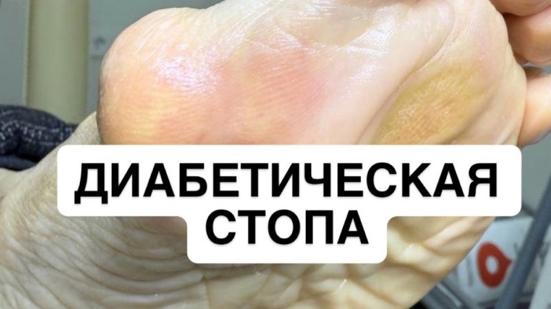 Диабетическая стопа