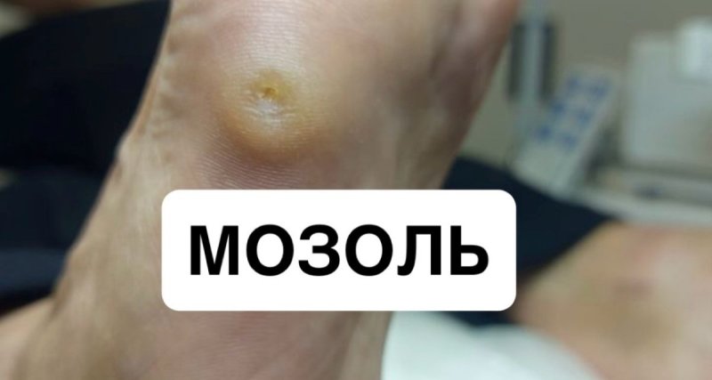 Опасность САМОЛЕЧЕНИЯ МОЗОЛЕЙ!