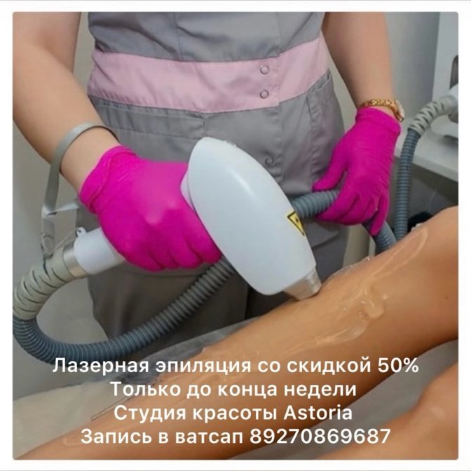 Лазерная эпиляция