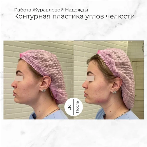 Возможности контурной пластики, практически, безграничны!💫