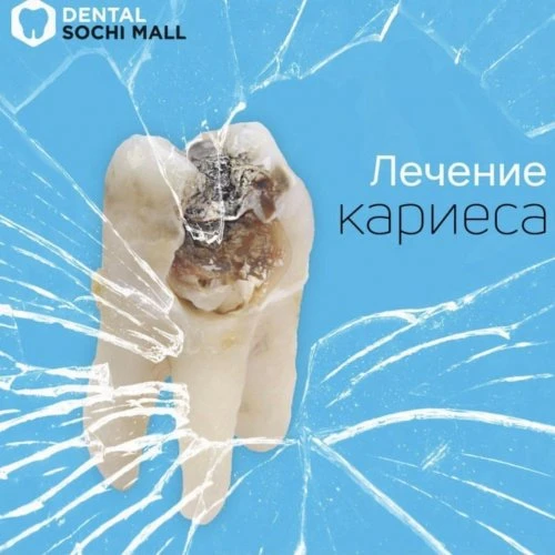 Лечение кариеса от 4000т. рублей Сочи