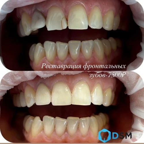 Композитные виниры  Сочи -7500р
