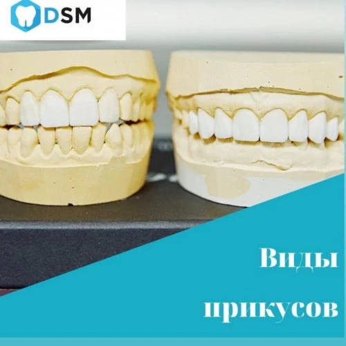 Виды прикусов.
