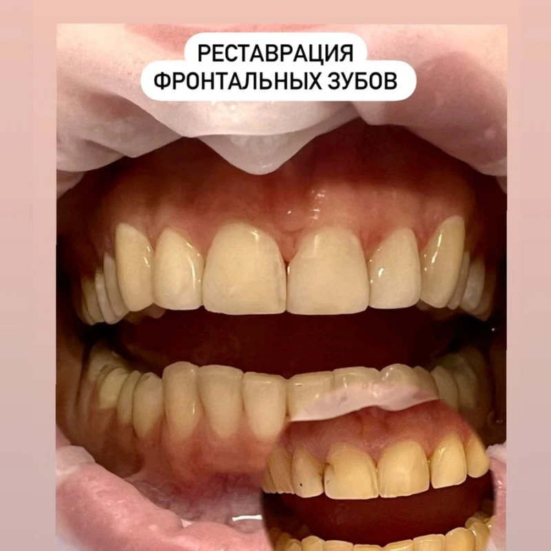 Реставрация зубов 7500р, Сочи!