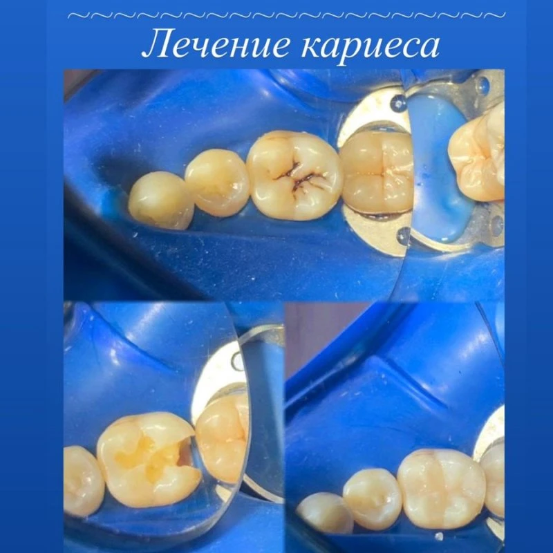 Лечение кариеса, Сочи!