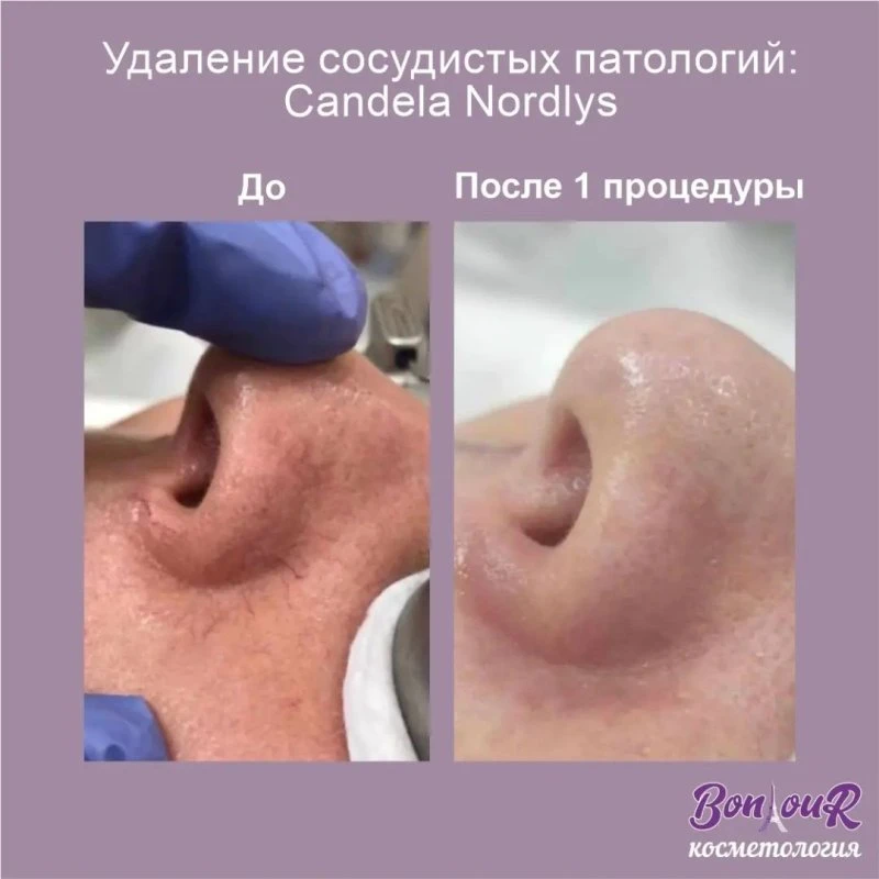 Мало что может испортить внешний вид носа так, как появление на нём сосудистых сеточек. 