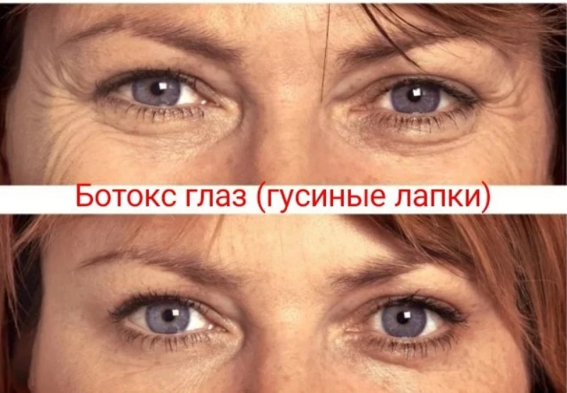 Ботокс